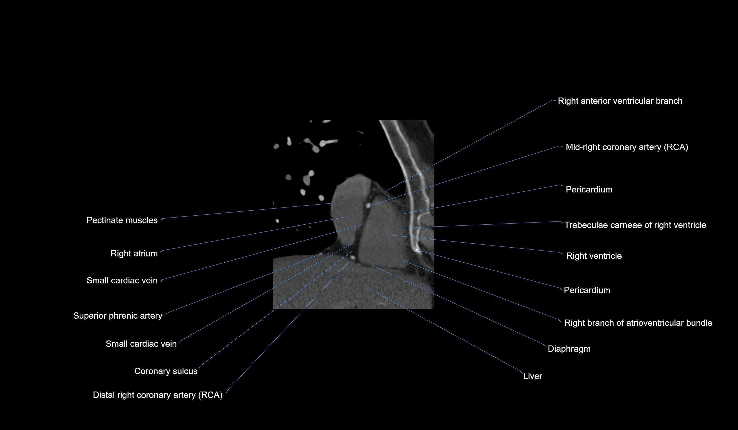 CT heart (coronary angiogram) 2 chamber view cross sectional anatomy labelled radiology image-00036.webp